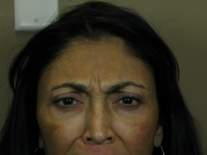 Botox Brow Before Albuquerque, Santa Fe, And Surrounding Areas