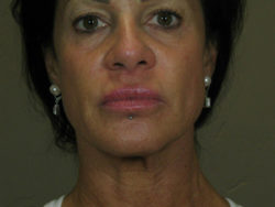 Botox and Fillers