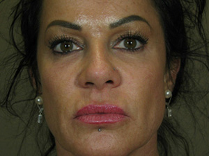 Botox and Fillers