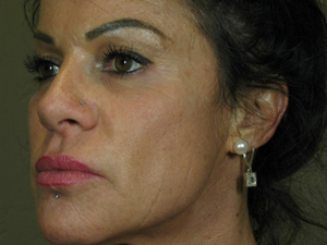 Botox and Fillers