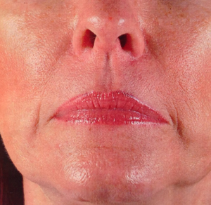 Botox and Fillers