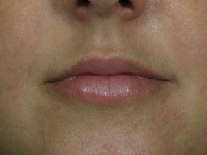 Results Lip Enhancement - Restylane Albuquerque