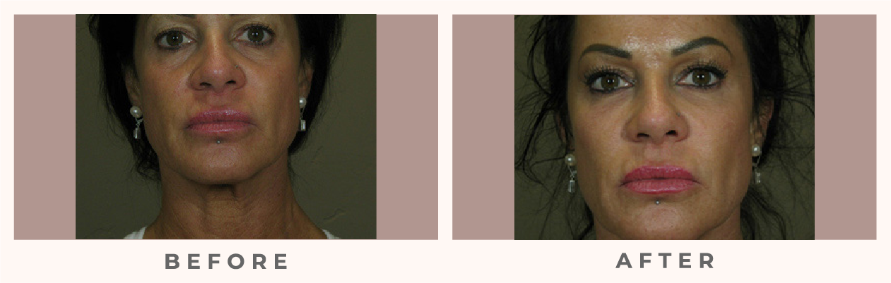 Botox and Fillers before and after