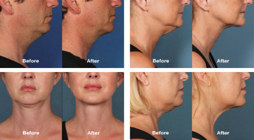 kybella-results