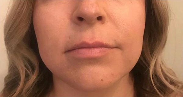 Fillers
